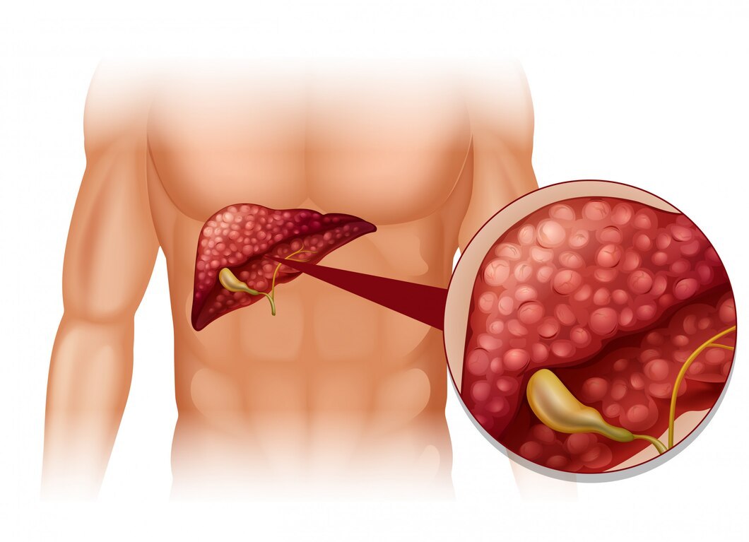 Будьте внимательны: желчный пузырь — как не навредить своему органу