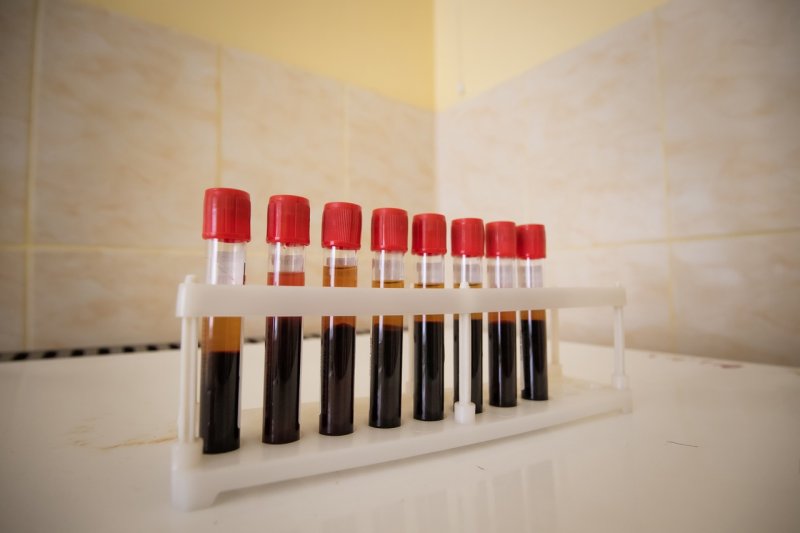 72 случая коронавируса за сутки в Мурманской области