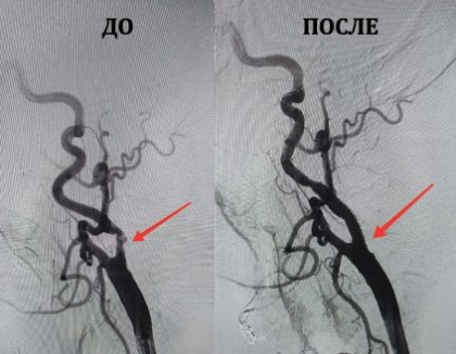 Впервые выполнили стентирование сонных артерий врачи мурманской «Пироговки»